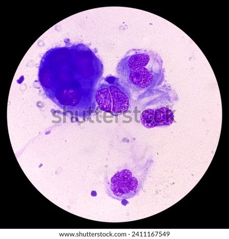 Ascitic fluid cytology. Leishman stain smear show Lymphocytes, polymorphs cells. Abnormal cells. Ascites. Royalty-Free Stock Photo #2411167549