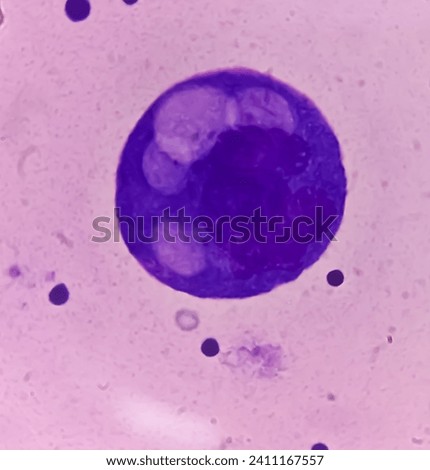Ascitic fluid cytology. Leishman stain smear show Lymphocytes, polymorphs cells. Abnormal cells. Ascites. Royalty-Free Stock Photo #2411167557