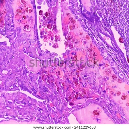 Thyroid cancer, Papillary thyroid microcarcinoma with nodular colloid goitre. Atypical thyroid follicular cells show nuclear clearing. Extensive fibrosis. Royalty-Free Stock Photo #2411229653