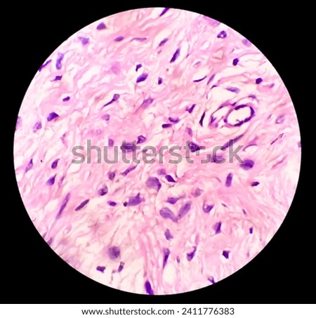Leg tissue biopsy: Photomicrographic image showing Fibromyxoma. Superficial Acral Fibromyxoma, rare slow growing myxoid tumor. Royalty-Free Stock Photo #2411776383