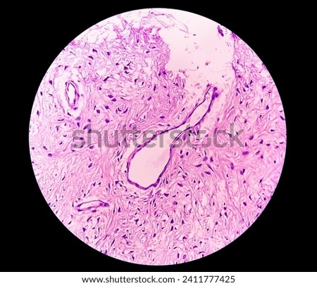 Leg tissue biopsy: Photomicrographic image showing Fibromyxoma. Superficial Acral Fibromyxoma, rare slow growing myxoid tumor. Royalty-Free Stock Photo #2411777425