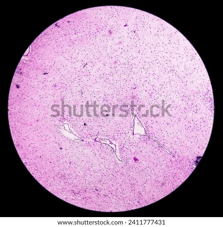 Leg tissue biopsy: Photomicrographic image showing Fibromyxoma. Superficial Acral Fibromyxoma, rare slow growing myxoid tumor. Royalty-Free Stock Photo #2411777431