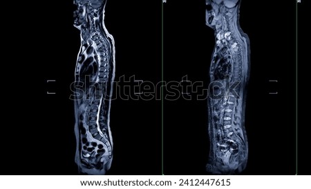 An MRI of the whole spine image is a comprehensive visual representation produced through Magnetic Resonance Imaging, providing detailed insights into the entire spinal structure. Royalty-Free Stock Photo #2412447615