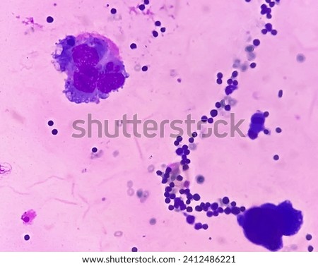Ascitic fluid cytology. Leishman stain smear show Lymphocytes, polymorphs cells. Abnormal cells. Ascites. Royalty-Free Stock Photo #2412486221