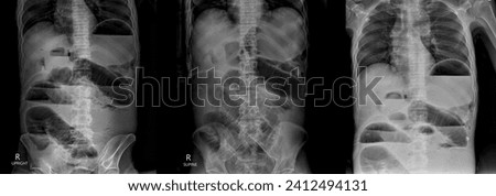 Xray radiograph on dark background in hospital.Doctor used xray for diagnosis of the illness of patient.x-ray of acute abdomen series shown small gut or bowel obstruction.Emergency surgery.Close loop. Royalty-Free Stock Photo #2412494131