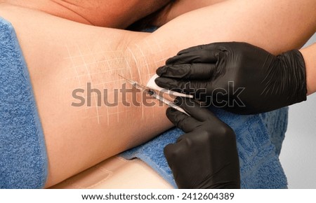 The doctor makes intramuscular injections of botulinum toxin in the underarm area against hyperhidrosis. Royalty-Free Stock Photo #2412604389