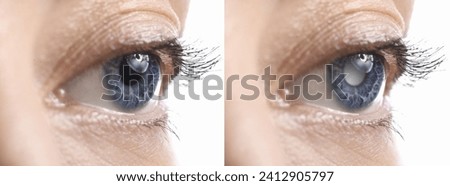 Closeup view of woman before and after glaucoma treatment on white background, closeup Royalty-Free Stock Photo #2412905797
