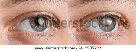 Closeup view of man before and after glaucoma treatment, closeup Royalty-Free Stock Photo #2412905799