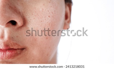 Asian face, Macro skin with enlarged pores. Allergic reaction, peeling, care for problem skin. Royalty-Free Stock Photo #2413218031