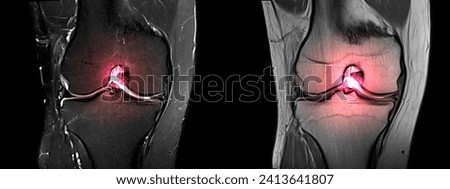 Magnetic resonance imaging or MRI of knee.Closed injury of the knee joint, with manifestations of arthrosis.Knee pain in sport injury.Orthopedic surgeon plan cruciate ligament reconstruction surgery. Royalty-Free Stock Photo #2413641807