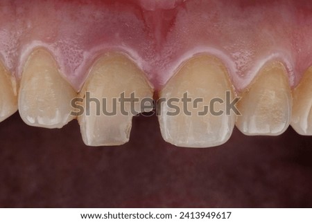 Chipped tooth.Chipped piece of a dead pulp tooth. Restoration of a  defect in tooth enamel, thin tooth walls. Macro, treatment Royalty-Free Stock Photo #2413949617