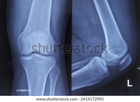 X-ray of knee joint AP and lateral view. Small fracture fragment-possibly arising from lateral condyle of femur. Soft tissue appears swollen. Royalty-Free Stock Photo #2414172901