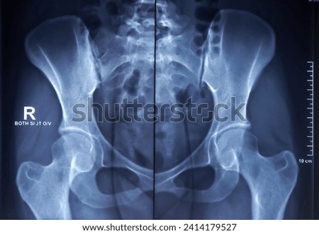X-ray image of female pelvic. Scleroses are noted at the articular margins of both SI joints. Royalty-Free Stock Photo #2414179527