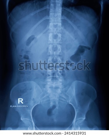 Plain X-ray of Abdomen in erect posture. Large bowel loops are distended with gas and loaded faecal matters. Linear radio opaque shadow suggest matallic foreign body at abdomenal region. Royalty-Free Stock Photo #2414315931
