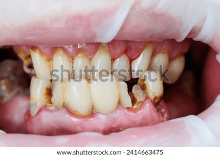 cracked teeth. Chipped tooth.Chipped piece of a dead pulp tooth. Restoration of a defect in tooth enamel, thin tooth walls. Macro, treatment,Huge gap between the front teeth or incisors . Royalty-Free Stock Photo #2414663475