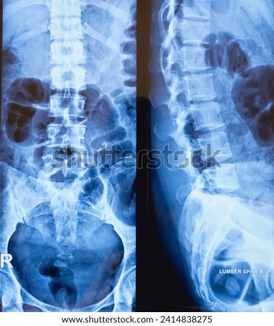 NORMAL-LUMBOSACRAL-SPINE Stock Photos and Images - Avopix.com