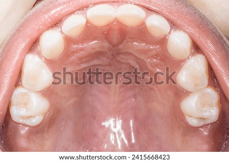 Upper maxillary arch occlusal view of a eight year old child dentition. Healthy gingival gum, palate, teeth aligned and no decay. Directly below view with mirror medical photography.  Royalty-Free Stock Photo #2415668423
