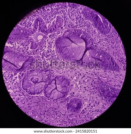 Rectal cancer. Rectum adenocarcinoma. IBD. IBS. Squamous cell carcinoma of the rectum. Grade 2 colorectal cancer, microscopic view. Royalty-Free Stock Photo #2415820151