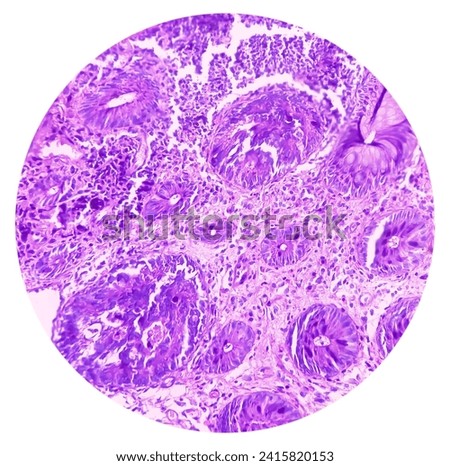 Rectal cancer. Rectum adenocarcinoma. IBD. IBS. Squamous cell carcinoma of the rectum. Grade 2 colorectal cancer, microscopic view. Royalty-Free Stock Photo #2415820153