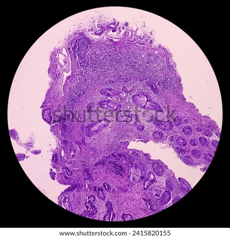 Rectal cancer. Rectum adenocarcinoma. IBD. IBS. Squamous cell carcinoma of the rectum. Grade 2 colorectal cancer, microscopic view. Royalty-Free Stock Photo #2415820155