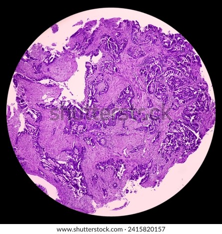 Rectal cancer. Rectum adenocarcinoma. IBD. IBS. Squamous cell carcinoma of the rectum. Grade 2 colorectal cancer, microscopic view. Royalty-Free Stock Photo #2415820157