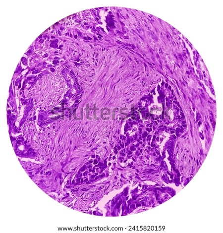 Rectal cancer. Rectum adenocarcinoma. IBD. IBS. Squamous cell carcinoma of the rectum. Grade 2 colorectal cancer, microscopic view. Royalty-Free Stock Photo #2415820159