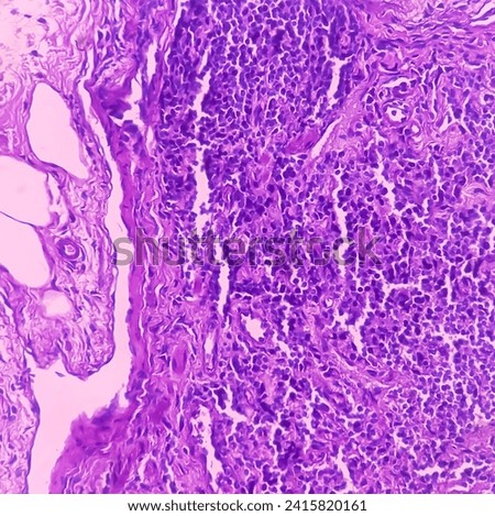Rectal cancer. Rectum adenocarcinoma. IBD. IBS. Squamous cell carcinoma of the rectum. Grade 2 colorectal cancer, microscopic view. Royalty-Free Stock Photo #2415820161
