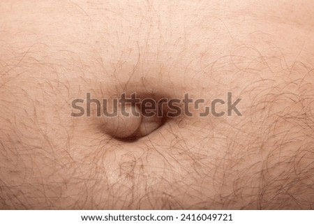 An umbilical hernia appears as a painless lump in or near the belly button (navel) Royalty-Free Stock Photo #2416049721