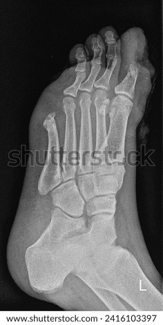 film X-ray show bone of human's foot