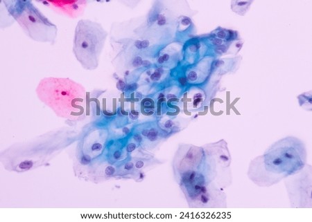 Abnormal squamous epithelial cells view in microscopy.Humanpapilloma virus (HPV) criteria for pap smear slide cytology.Koilocyte cells.Human cell medical concept background. Royalty-Free Stock Photo #2416326235