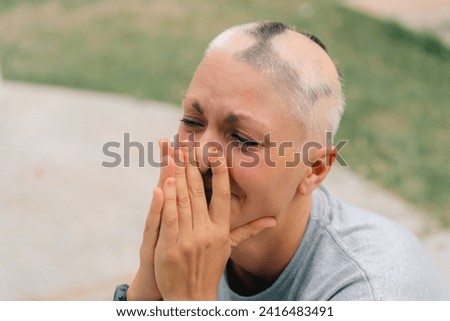 Real alopecia areata in a young girl. A bald head in a person. Diffuse alopecia. Androgenic alopecia. Hair loss. Bald spots on the head. Trichology. High quality photo Royalty-Free Stock Photo #2416483491