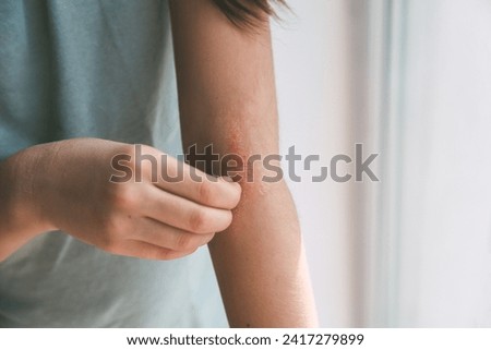 a girl scratches the skin on the elbow of her arm, redness is atopic dermatitis, the girl s face is not visible. Royalty-Free Stock Photo #2417279899
