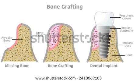 Bone grafting implant steps anatomy, teeth structure. Dental, tooth diagram. Bone titanium screw post, prosthetic crown, abutment, gum. Medical, periodontal. Vector illustration Royalty-Free Stock Photo #2418069103