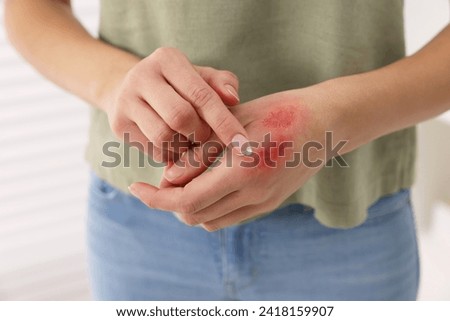 Woman applying healing cream onto burned hand indoors, closeup Royalty-Free Stock Photo #2418159907