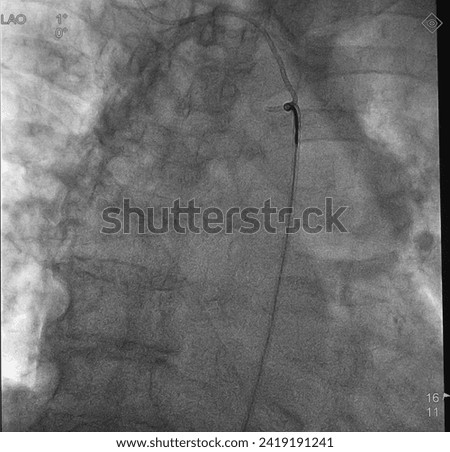 X ray image showed snare catheter pull tip of diagnosis catheter in ascending aorta. Royalty-Free Stock Photo #2419191241