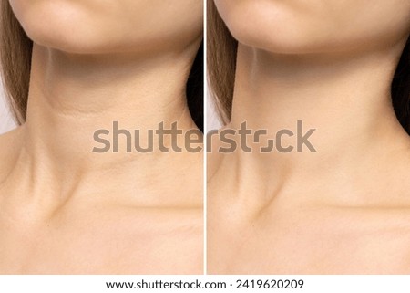 Crease and wrinkles on a woman’s neck before and after the rejuvenation procedure. Age-related changes. Treatment of lines and rings of Venus with collagen injections, plastic surgery, lifting. Beauty