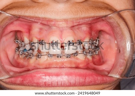 Frontal view of dental arches in biting teeth, orthodontic braces and arch wire. blue resin sealed on lower molars raising-up occlusion, diastema gap between upper central incisors and cheek retractor Royalty-Free Stock Photo #2419648049