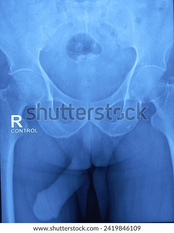 X-ray RGU,MCU. Short segment tight stricture at proximal part of anterior urethra. Long segment partial stricture with marginal irregular at anterior part of penile urethra along with meatal stenosis. Royalty-Free Stock Photo #2419846109