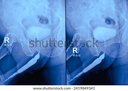 Short segment tight stricture at the proximal part of the anterior urethra. Long segment partial stricture with marginal irregular at anterior part of penile urethra along with meatal stenosis. X-ray. Royalty-Free Stock Photo #2419849341
