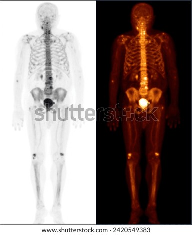 Pet bt ct scan or nuclear scan image of a patient showing normal skeleton of the whole body, Positron Emission Tomography or PET CT Scan of Human Body	 Royalty-Free Stock Photo #2420549383