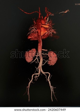 CT scan (computed tomography) of chest and abdominal organs in patient who has aortic dissection at descending aorta. Royalty-Free Stock Photo #2420607449