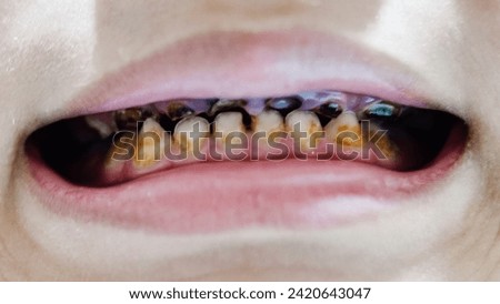 A child experiences early childhood caries which is characterized by damage to the anterior teeth which can be caused by consuming milk before bed. Royalty-Free Stock Photo #2420643047