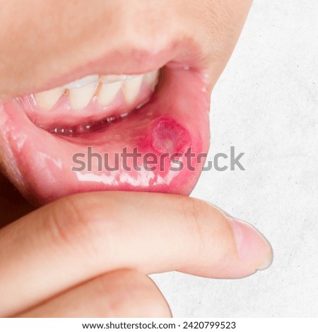 Close - up on the lip with aphthous stomatitis, aphthous ulcers on mouth on white background, selective focus.
 Royalty-Free Stock Photo #2420799523