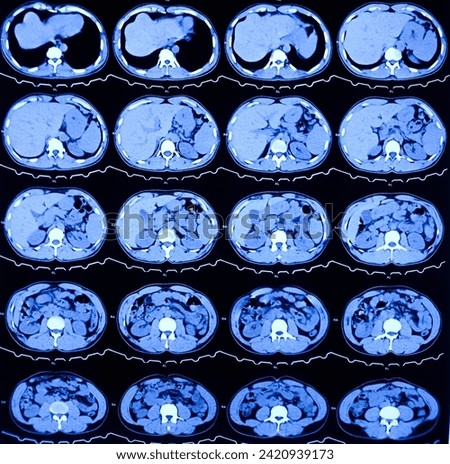 CT scan of HBS and Pancreas (Contrast): Solitary, non enhancing, hypodense lesion having ill defined margin noted. Atypical hemangioma or vascular malformation or mitotic lesion. Royalty-Free Stock Photo #2420939173