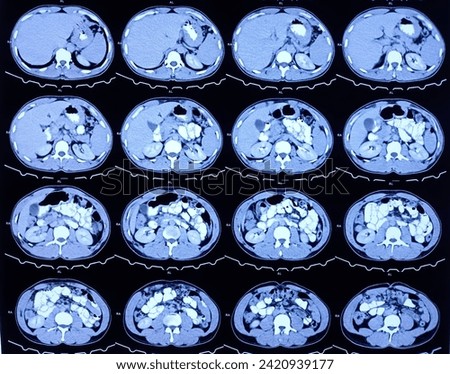 CT scan of HBS and Pancreas (Contrast): Solitary, non enhancing, hypodense lesion having ill defined margin noted. Atypical hemangioma or vascular malformation or mitotic lesion. Royalty-Free Stock Photo #2420939177