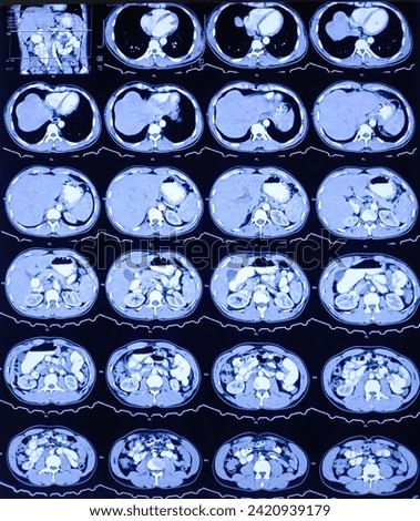 CT scan of HBS and Pancreas (Contrast): Solitary, non enhancing, hypodense lesion having ill defined margin noted. Atypical hemangioma or vascular malformation or mitotic lesion. Royalty-Free Stock Photo #2420939179