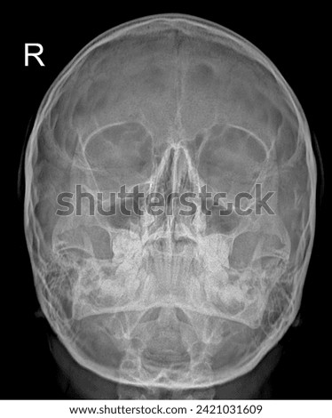 X-ray, skull, Waters' view technique