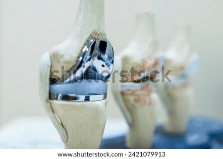 Knee joint model or mock-up with knee replacement prosthesis in osteoarthritis or knee pain patient. Orthopedic doctor or surgeon explains about surgery.Selective focus with blur background. Royalty-Free Stock Photo #2421079913
