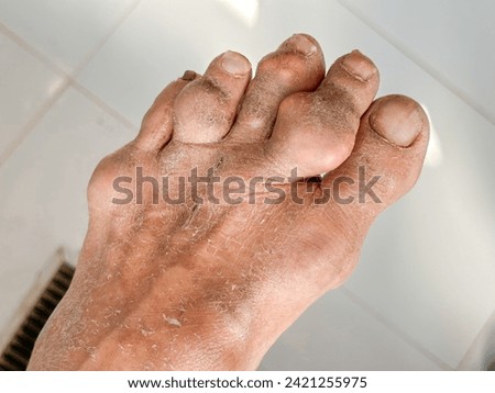 Patient Gout disease and rheumatoid arthritis Hand gouty and toes in hospital  defective metabolism uric acid. Rheumatoid poly arthritis on hand and foot concepts  Royalty-Free Stock Photo #2421255975