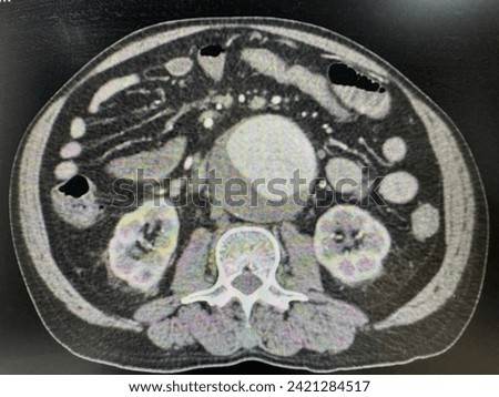 CTA whole aorta without rupture Royalty-Free Stock Photo #2421284517